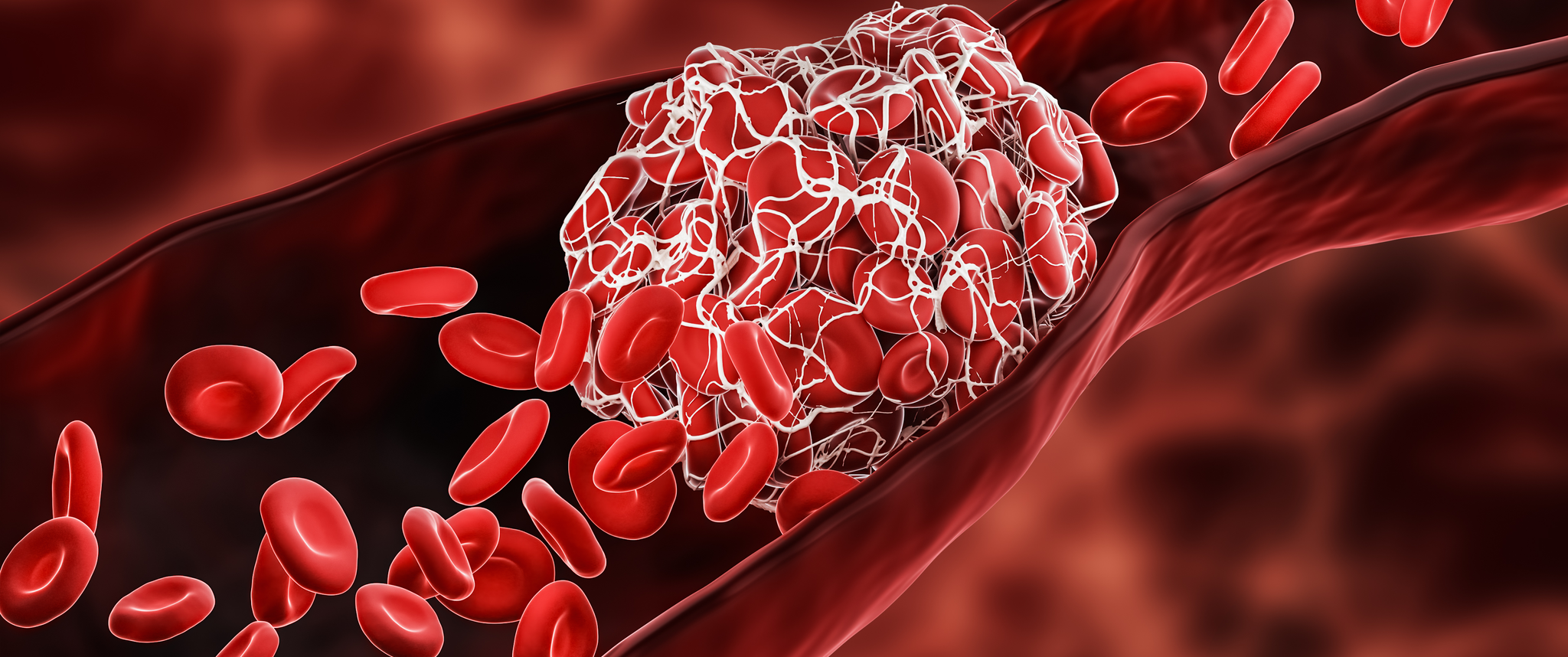 A blood clot in the vein