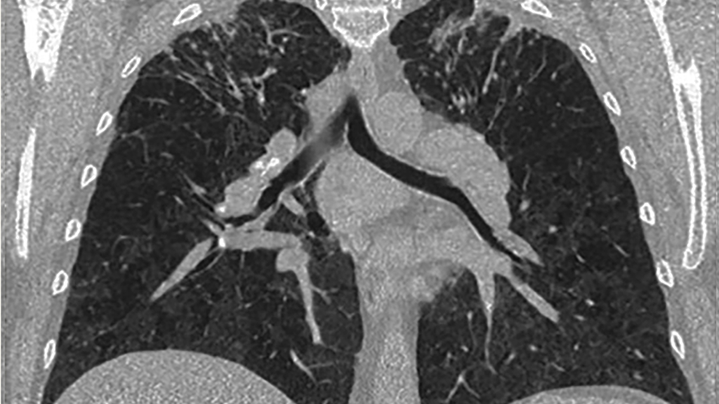 A high-resolution CT lung scan displaying scarring typical of beryllium-induced disease