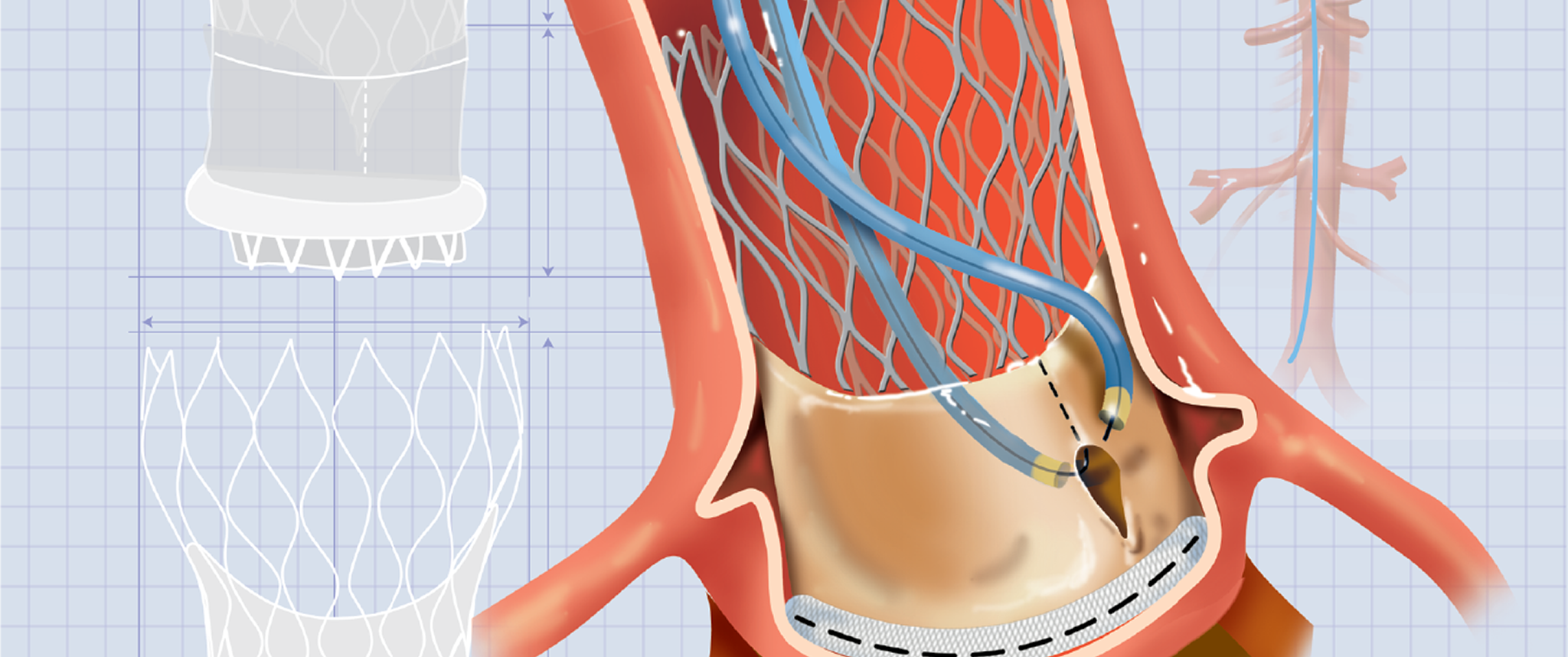 percutaneous electrocautery knife lacerating an aortic valve leaflet during BASILICA procedure