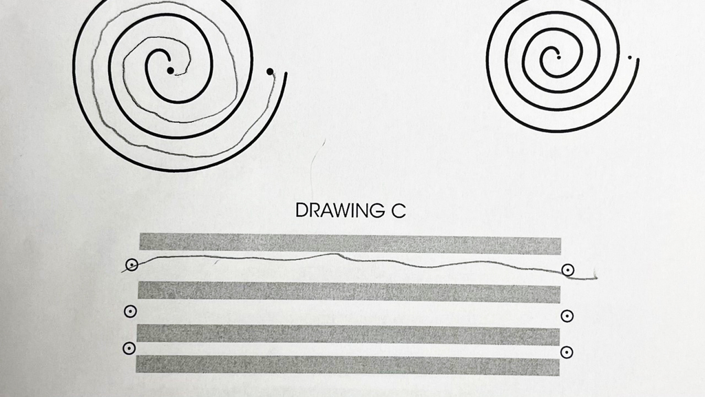 Image of a post-treatment spiral drawing done by the patient