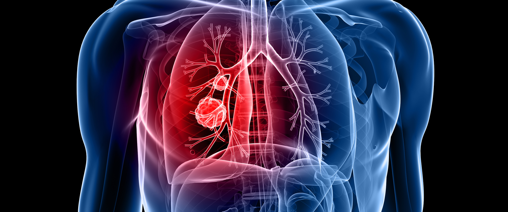 A 3D illustration of cancer cells in the lungs