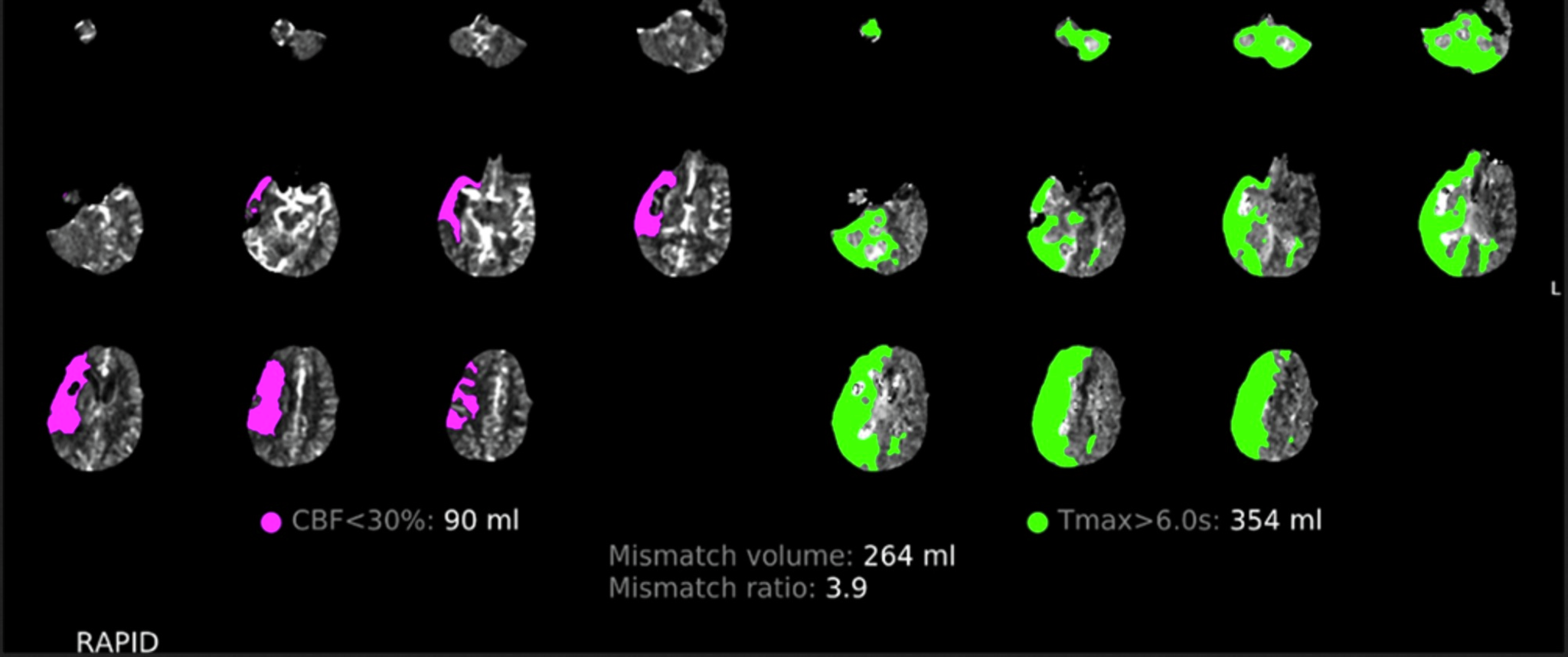 CT perfusion of injured brain core on left in pink, and penumbra (area expected to die if blood flow is not restored) on right in green