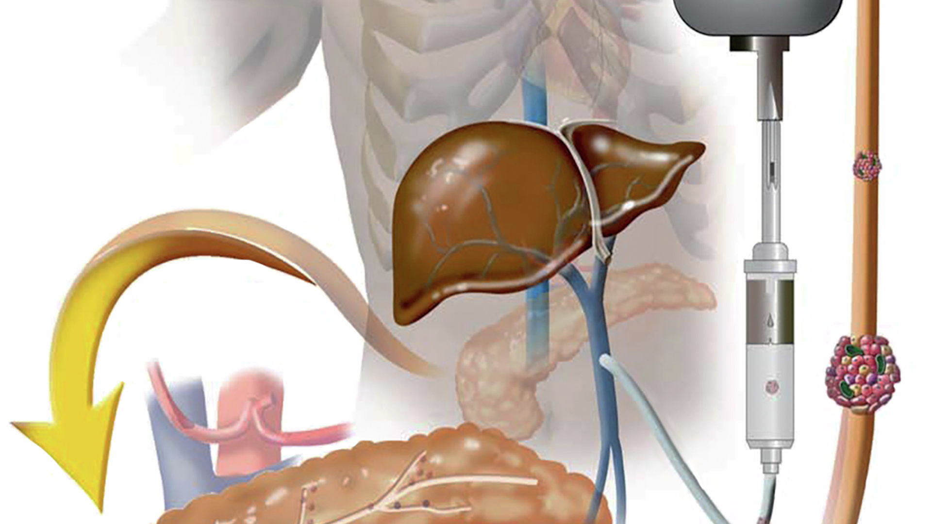 Separation and purification of islet cells from a diseased pancreas
