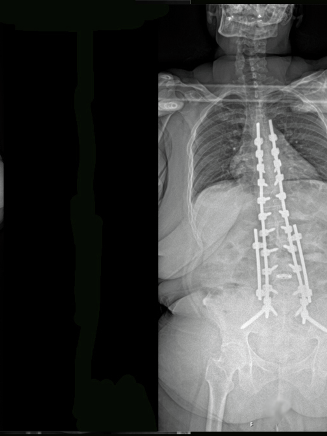 A pair of X-rays demonstrate the effects of surgery and full spinal instrumentation to straighten severe forward curvature of the spine
