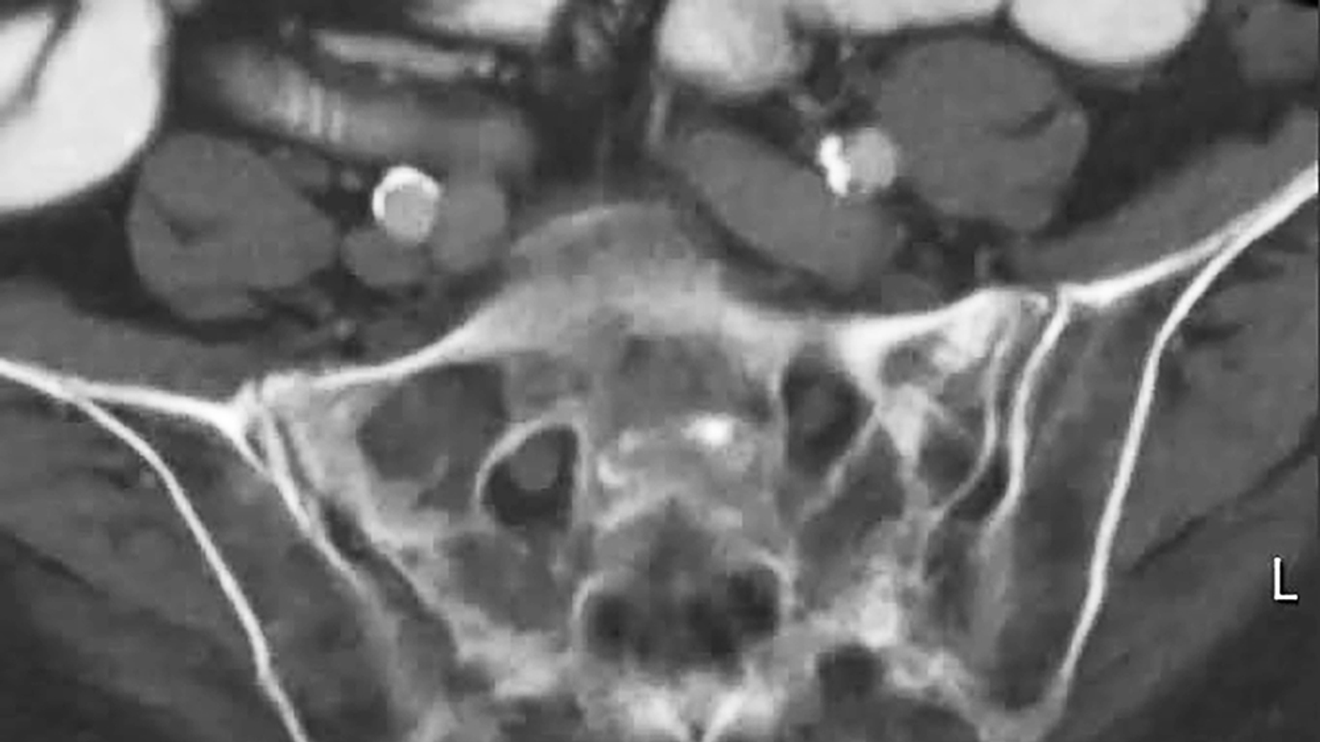 Pelvic CT scan of fracture