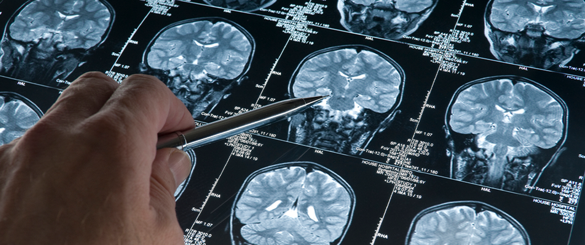 A hand with a pen points to brain scan images on a lightbox