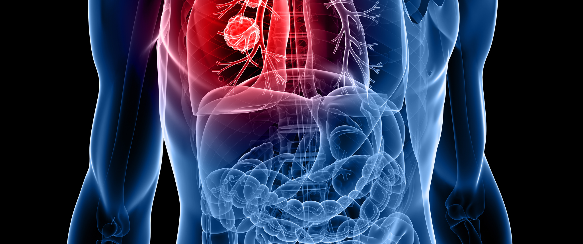 A 3D illustration of cancer cells in the lungs