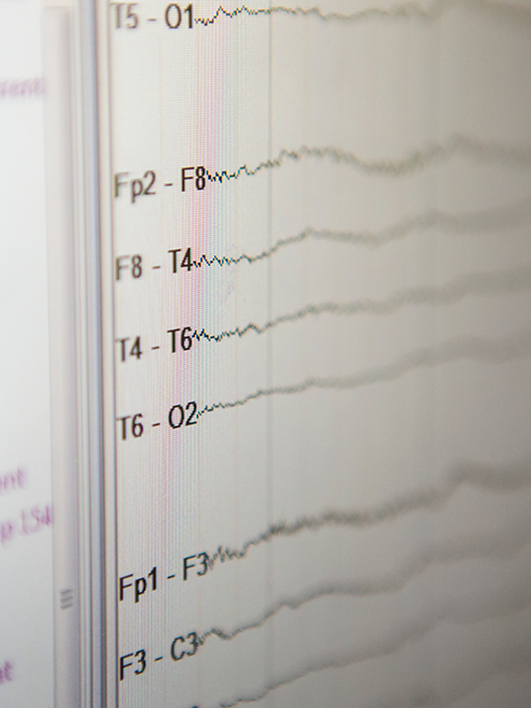 An electroencephalogram (EEG) print-out is shown