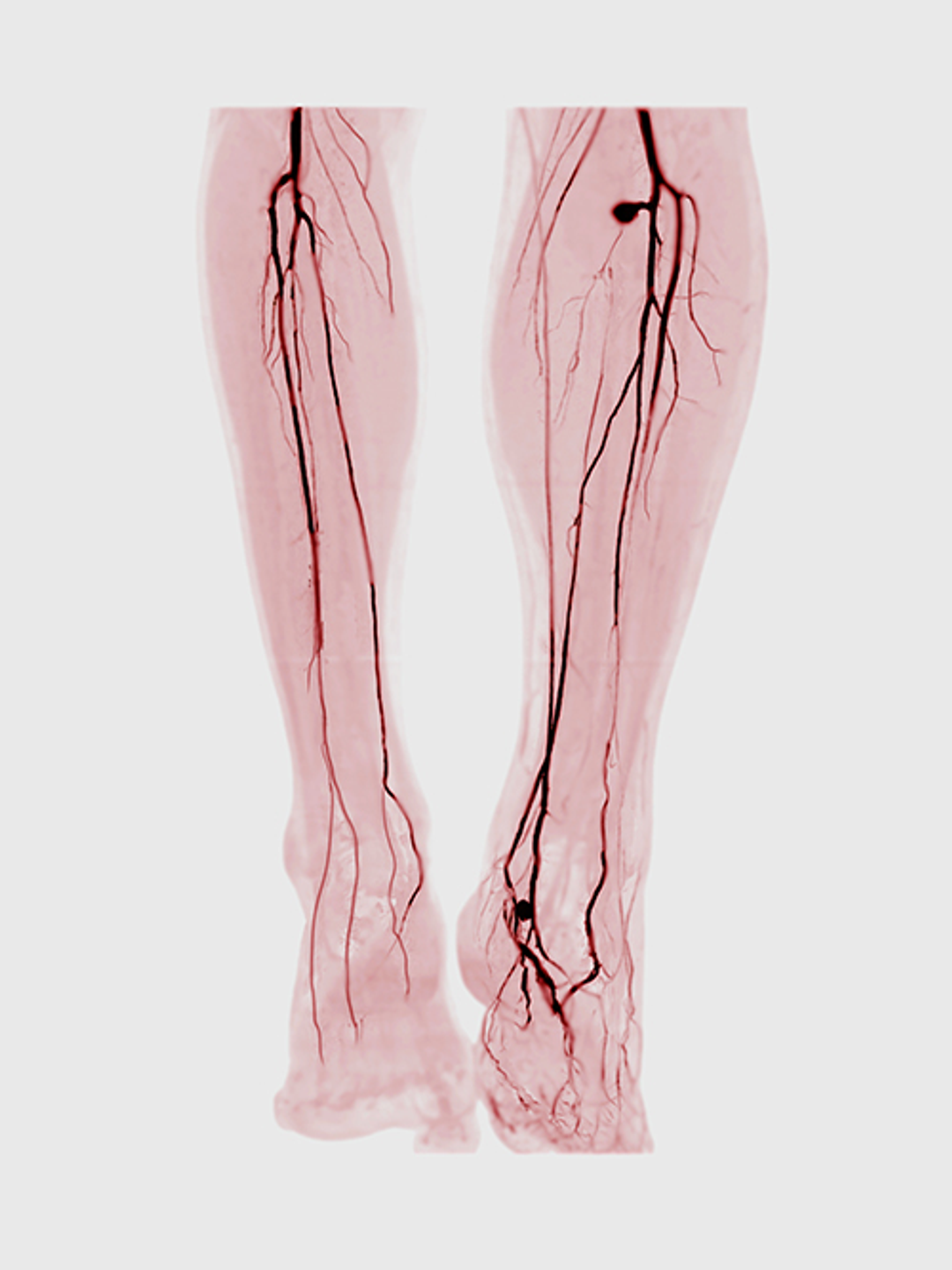 An angiogram of the legs is shown, demonstrating blockages in multiple arteries
