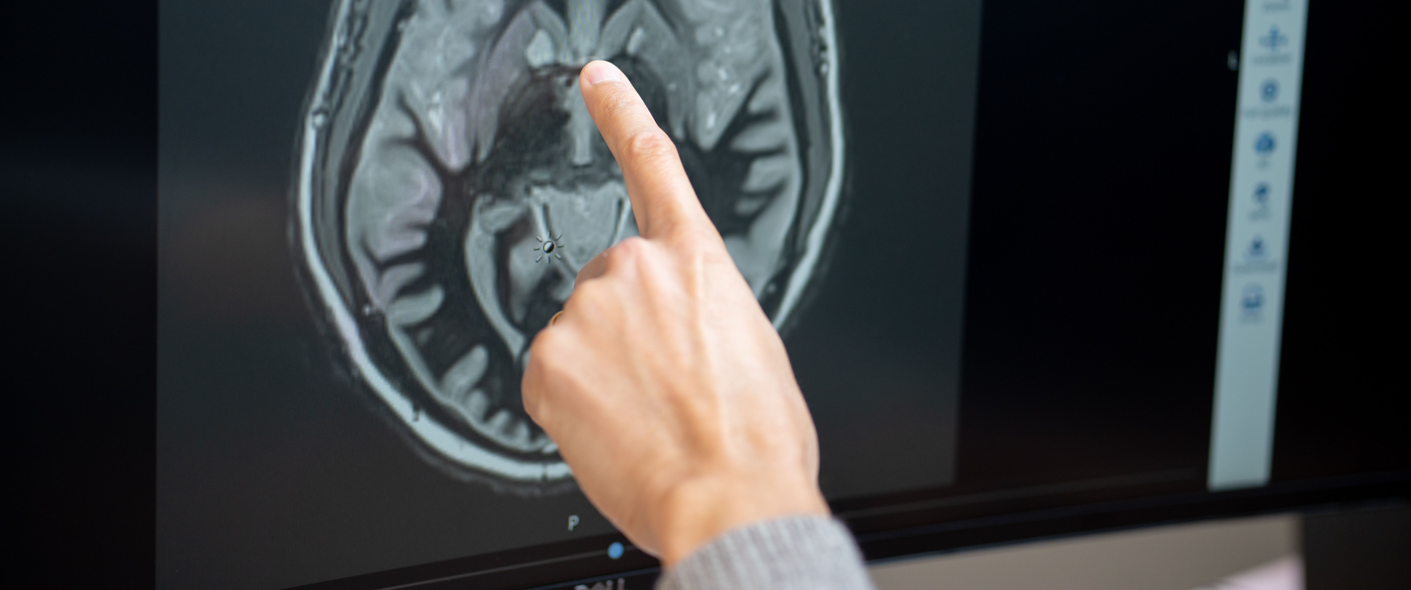 CT scan of human brain with doctor pointing at the structure in the center