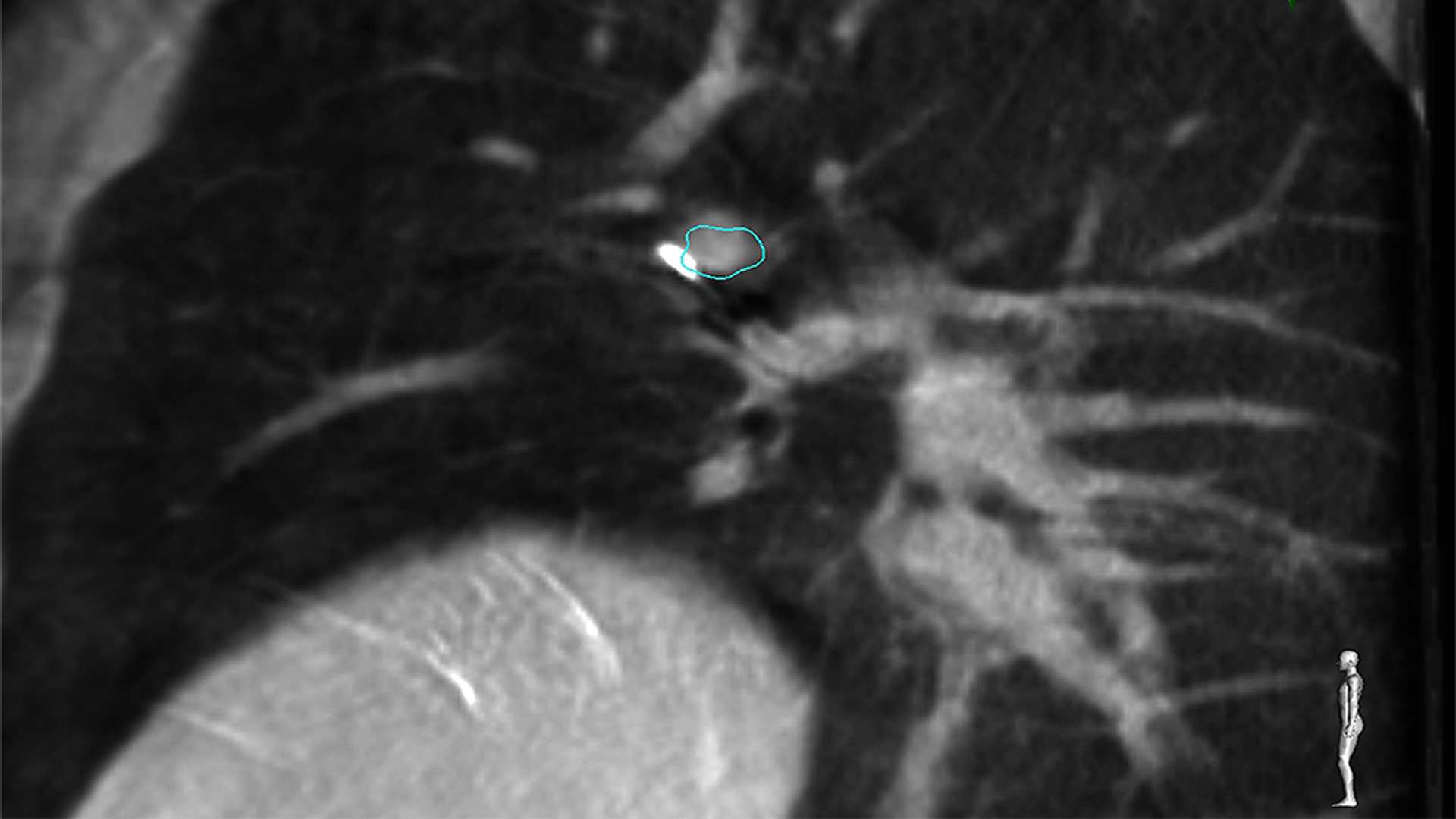 CT scan of lung demonstrating transthoracic needle piercing target lung lesion