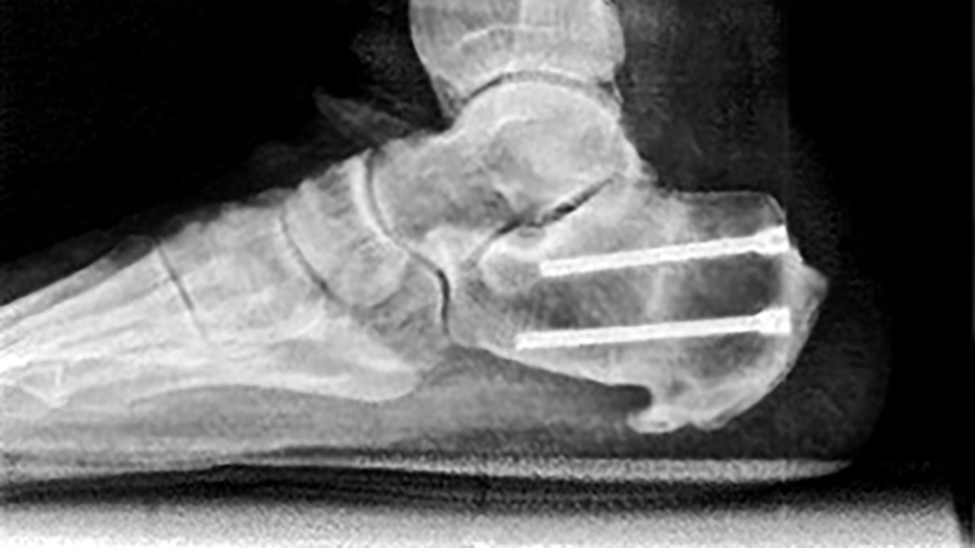 X ray shows screws placed through right heel following wedge osteotomy