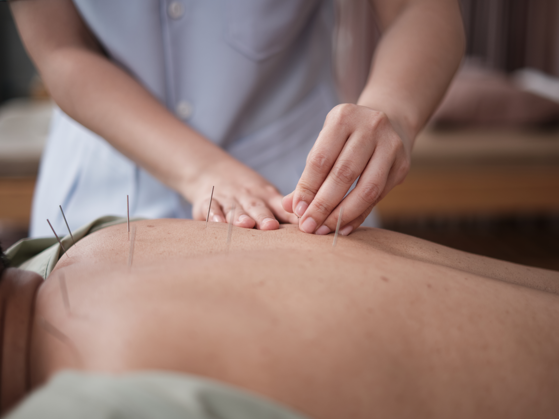 acupuncture procedure on back