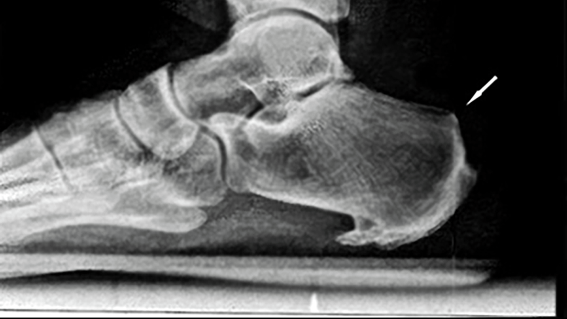 X-ray shows right foot and ankle with arrow pointing to deformity at top of heel