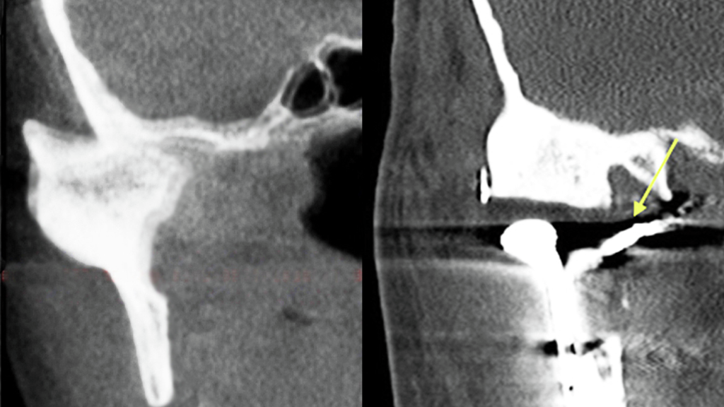CT scans showing TMJ bony growth (ankylosis) and jaw fusion before TMJ replacement surgery (A) and after resection of bony mass and TMJ replacement (B)