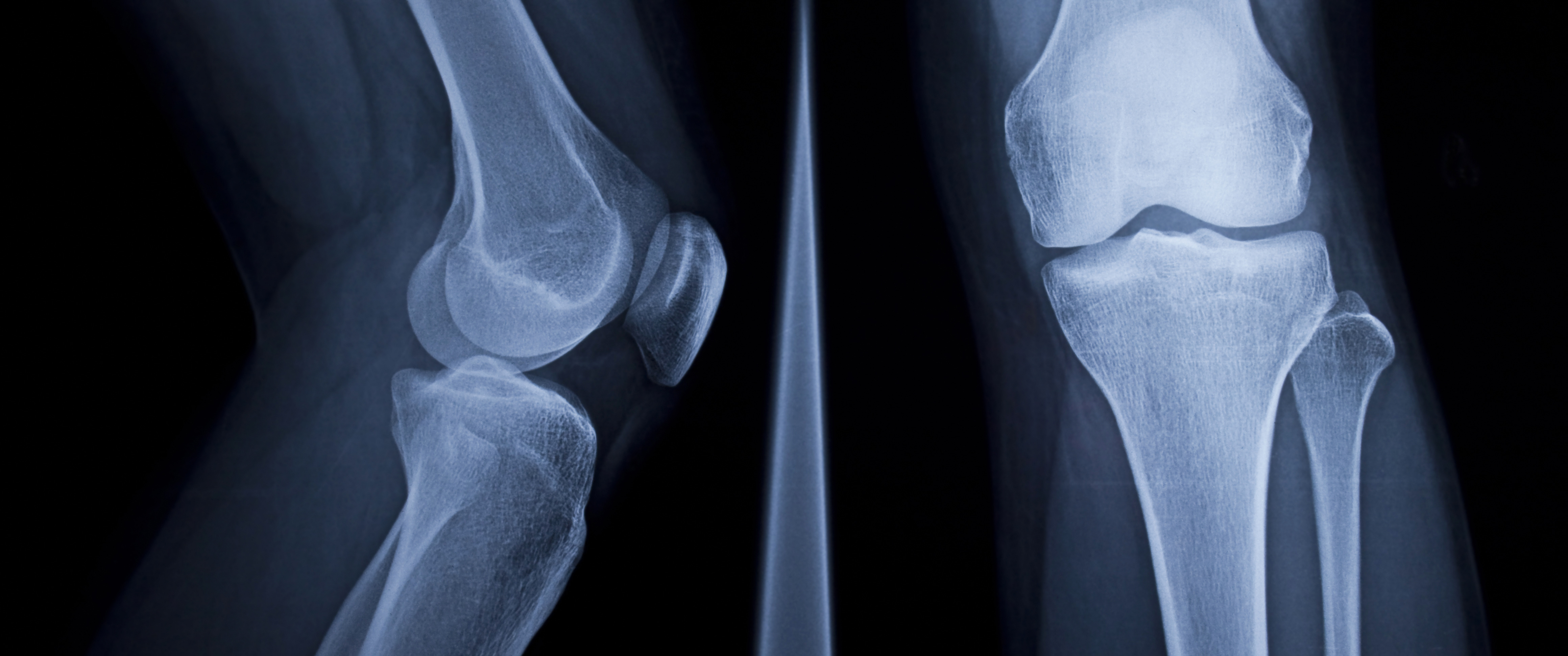 X-ray scan of bones