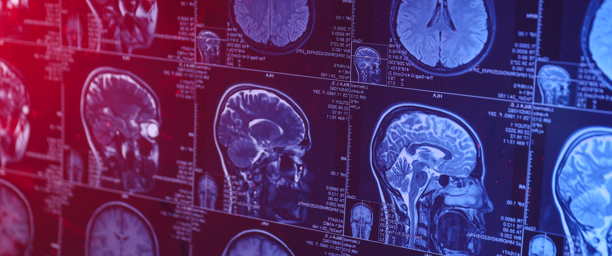 Closeup of MRI scan of the head and brain