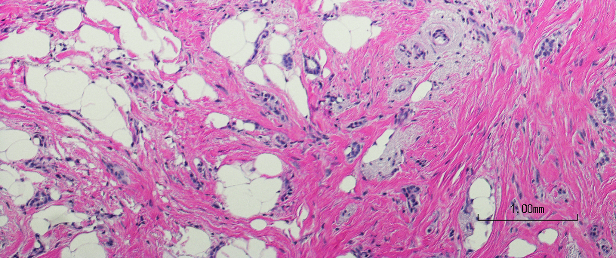 Microscopic image demonstrating breast tissue bearing invasive ductal carcinoma.