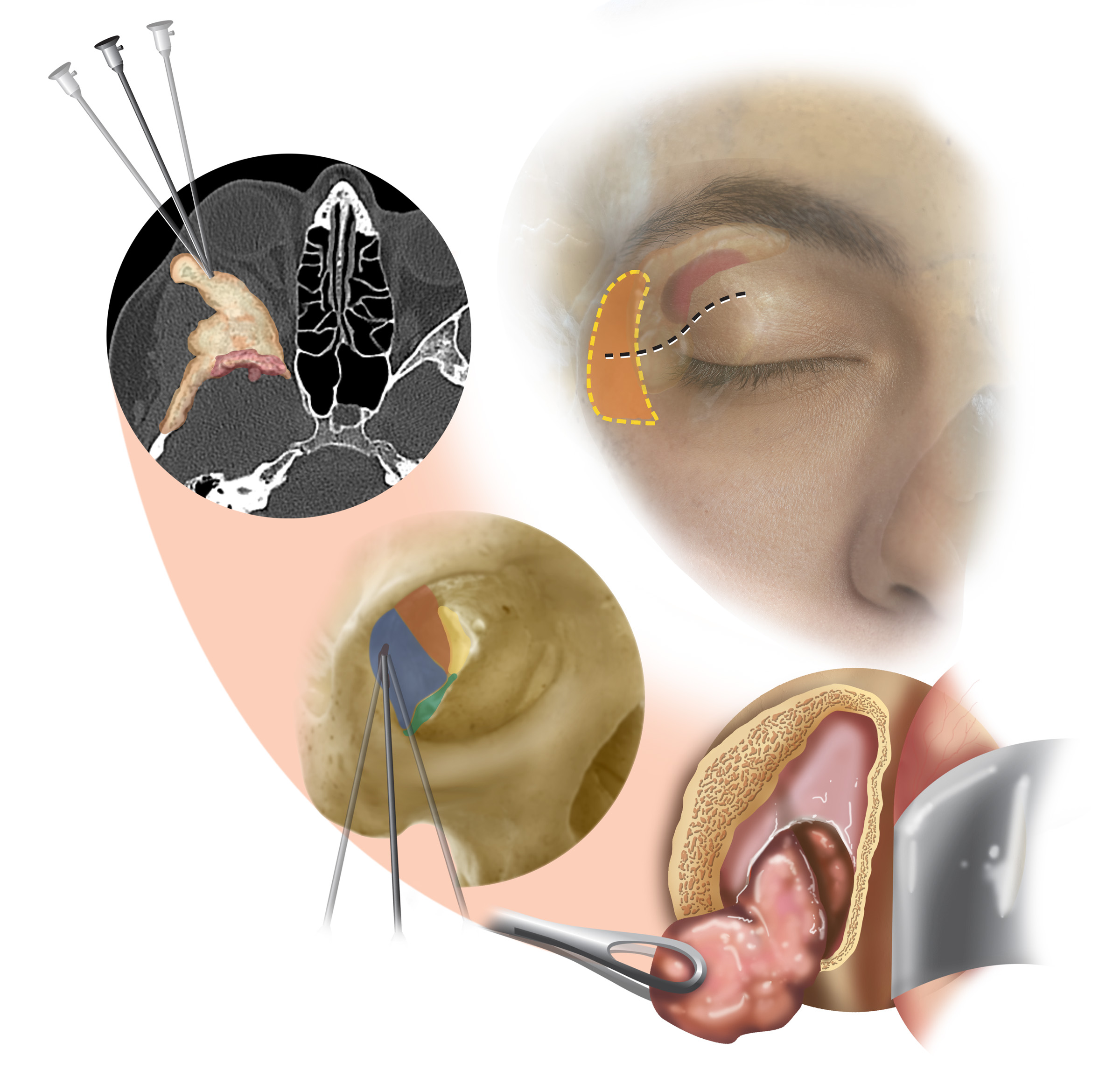An artistic collage of images demonstrates the processes of the transorbital approach to neurosurgery, from endoscopic entry at the orbit of the eye to removal of a lesion.