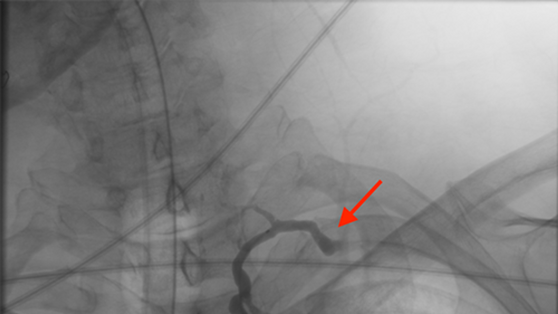 Thoracic duct demonstrating blockage