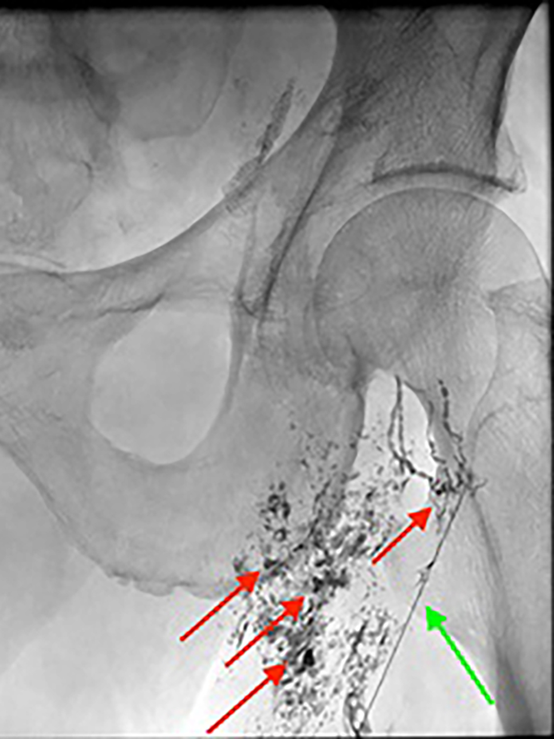 Stent opens occluded carotid artery