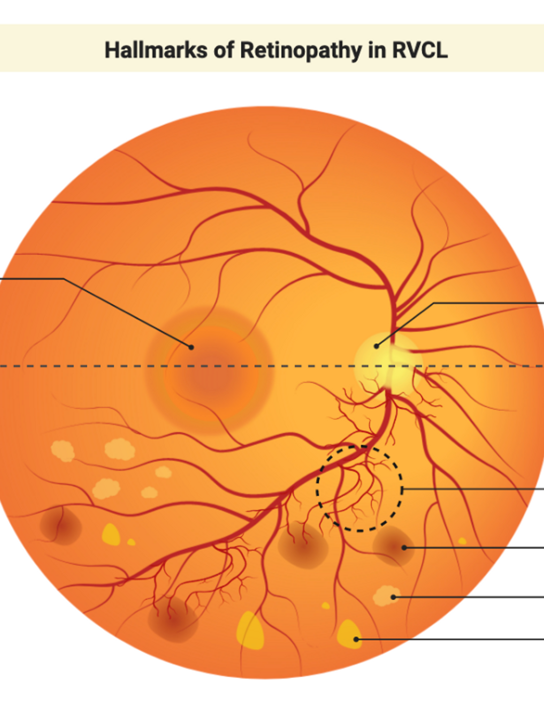 An illustration compares the normal eye to an eye affected by retinal vasculopathy