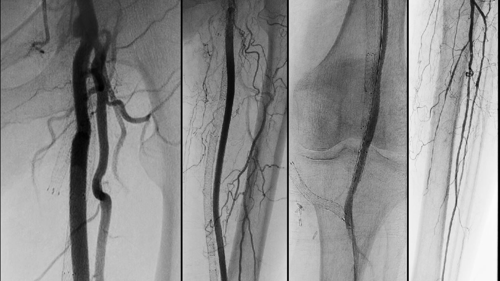 Four scans demonstrate the restoration of blood flow to the lower leg when blood is diverted from the femoral artery into stents in the femoral vein to bypass a long clot
