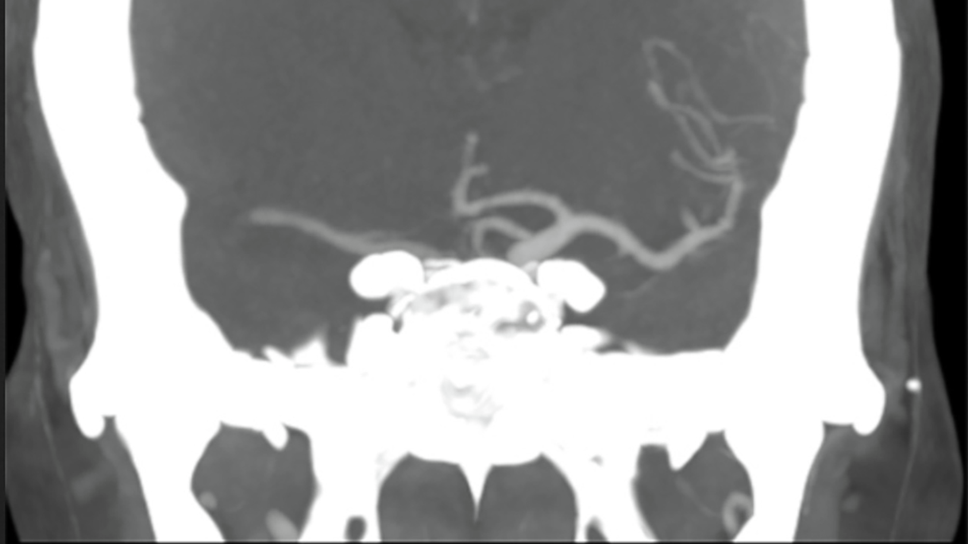 CT shows open vessels on the left and a blocked middle cerebral artery on the right