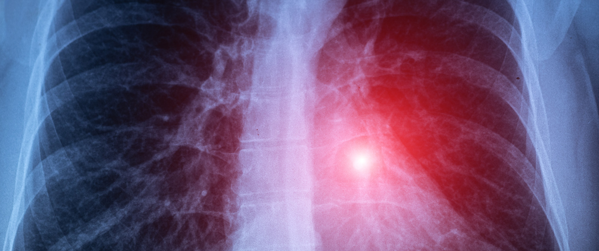 A lung X-ray shows glowing cancer cells. 