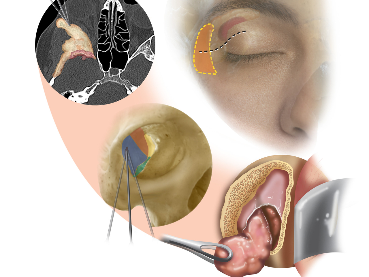 An artistic collage of images demonstrates the processes of the transorbital approach to neurosurgery, from endoscopic entry at the orbit of the eye to removal of a lesion.
