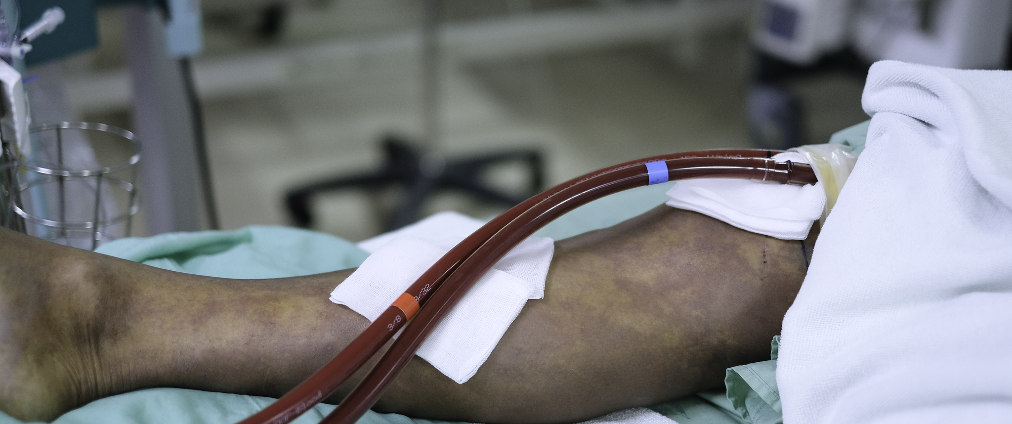 A patient's leg with extracorporeal membrane oxygenation line (ECMO) in hospital bed