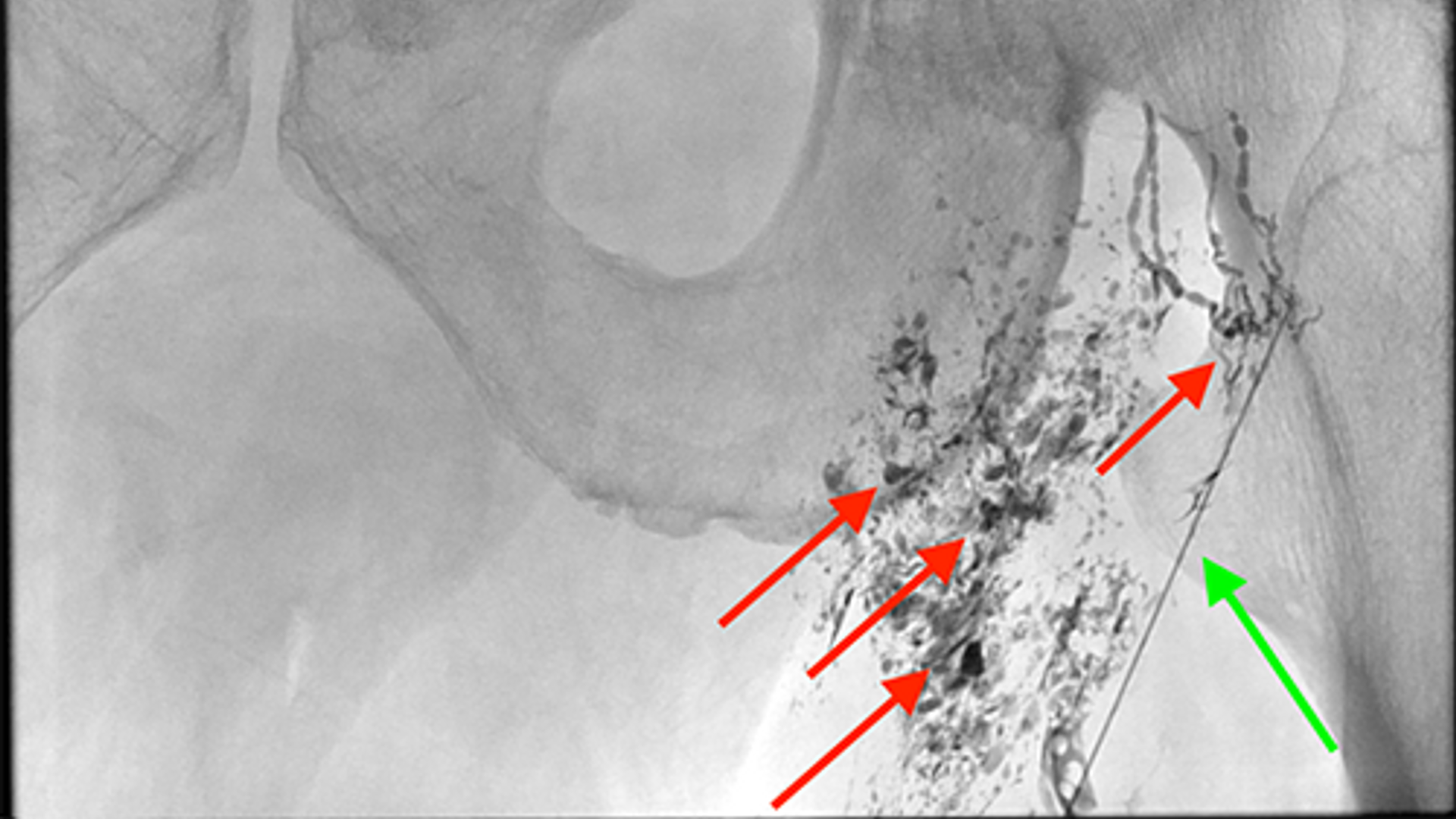 Inguinal lymph nodes with arrows indicating access to thoracic duct