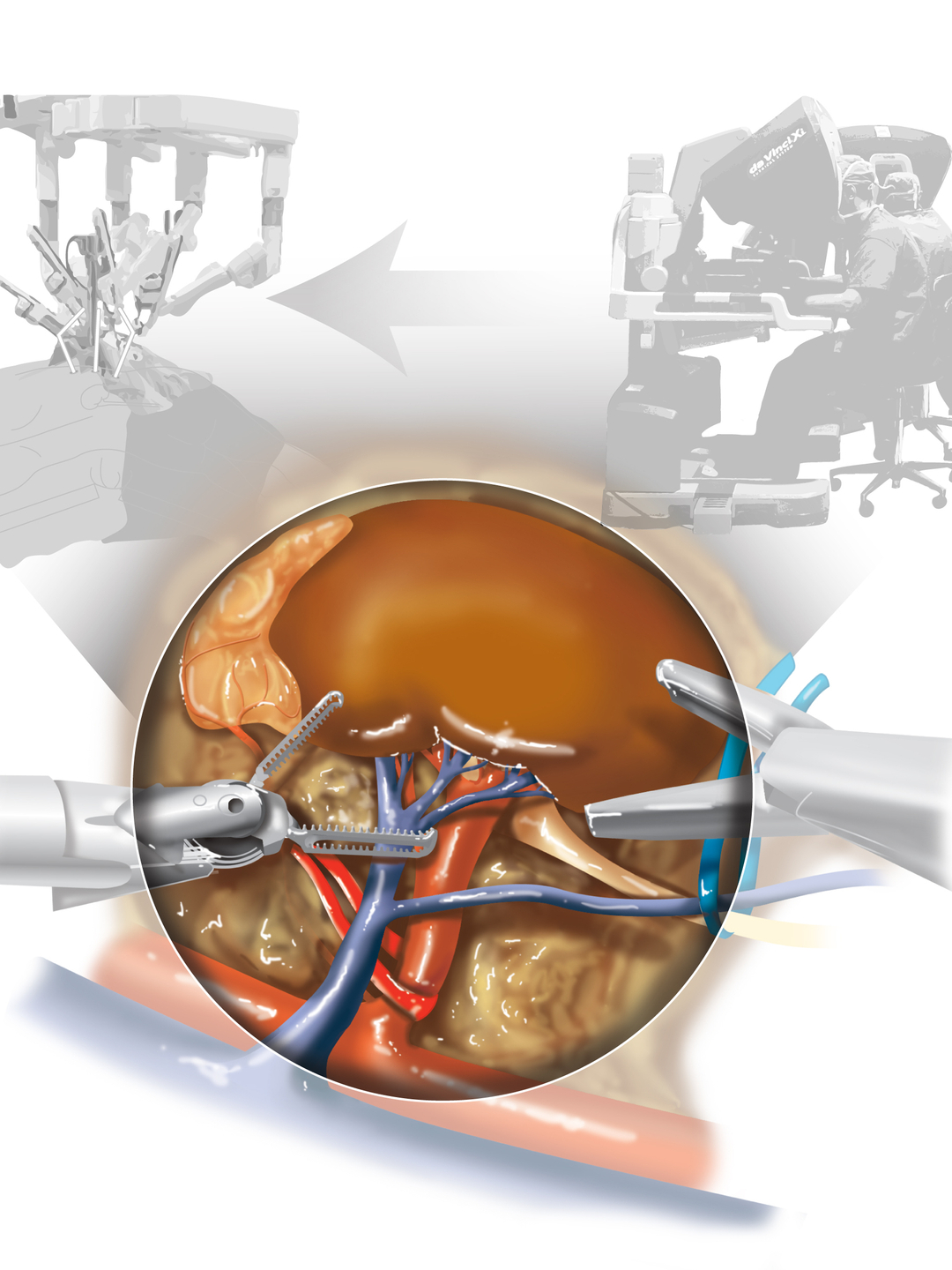 An artistic rendering highlights the use of robotic instruments during robotic living donor kidney surgery