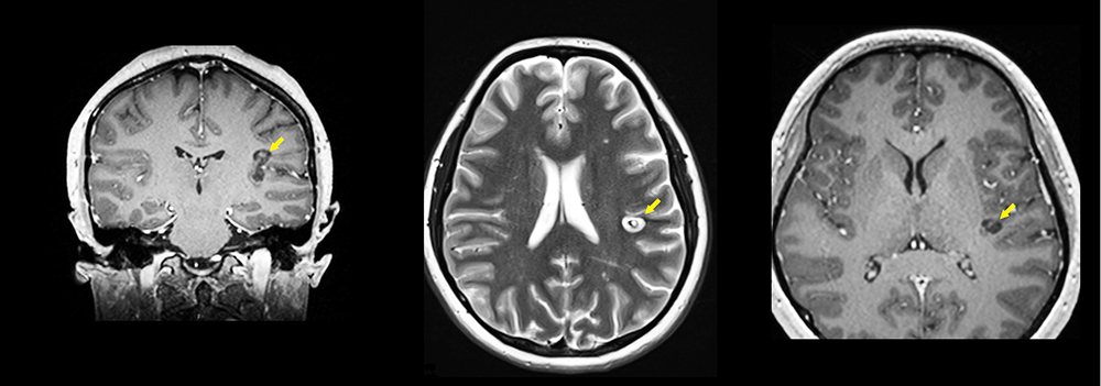Brain scans (3) after LITT showing elimination of seizure source