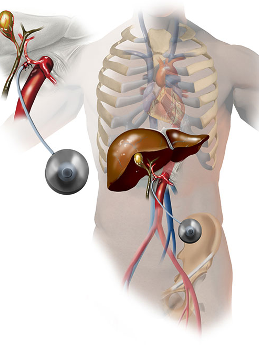Medical illustration detailing the steps of a hepatic artery infusion