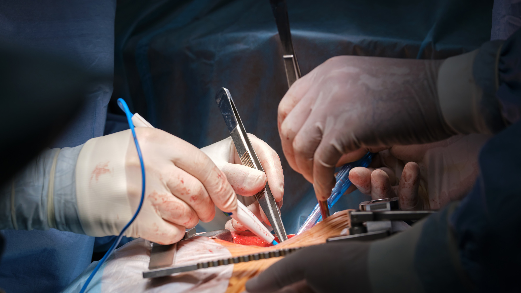 A pair of surgeons' hands are shown holding instruments over a patient's chest during open heart surgery.