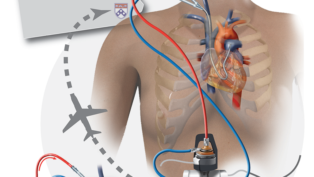 Depiction of ECMO patient journey Florida to Penn Medicine and ECMO and Oxy-RAD devices