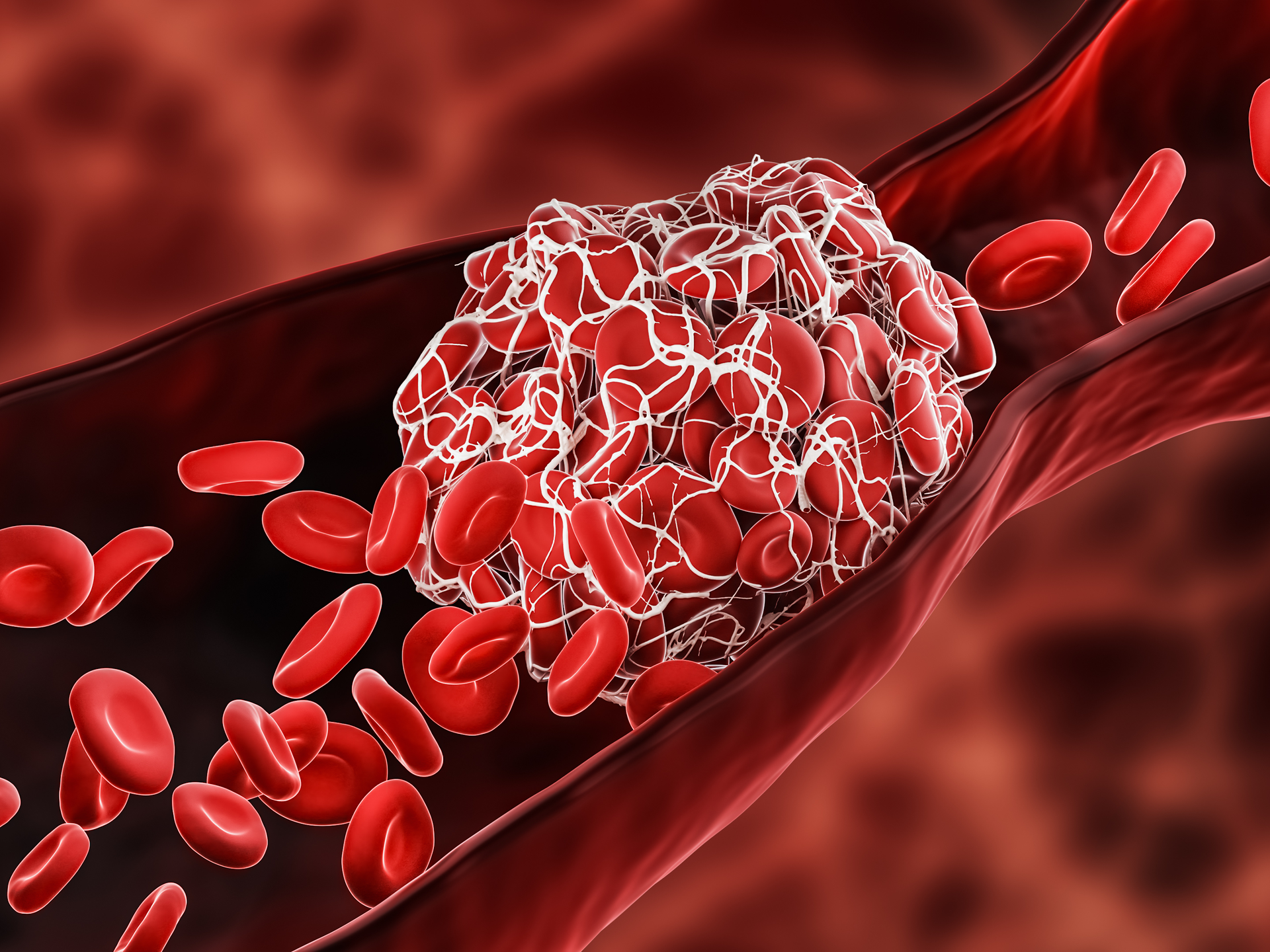 Blood Clot or thrombus blocking the red blood cells stream within an artery