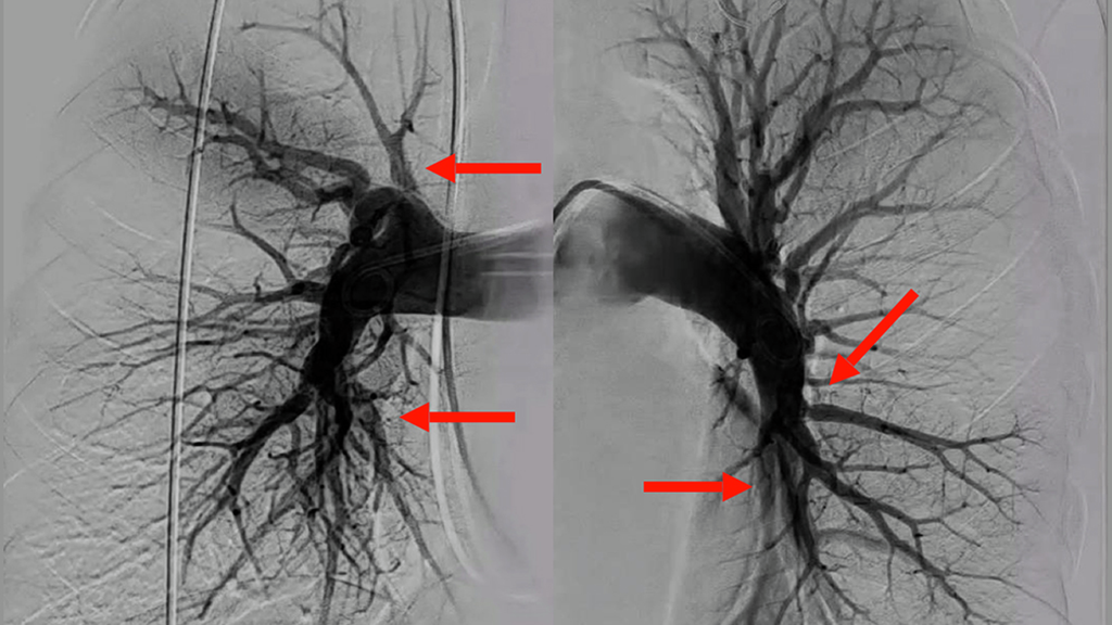 A pulmonary angiogram shows areas of blood clot (arrows) in the lungs