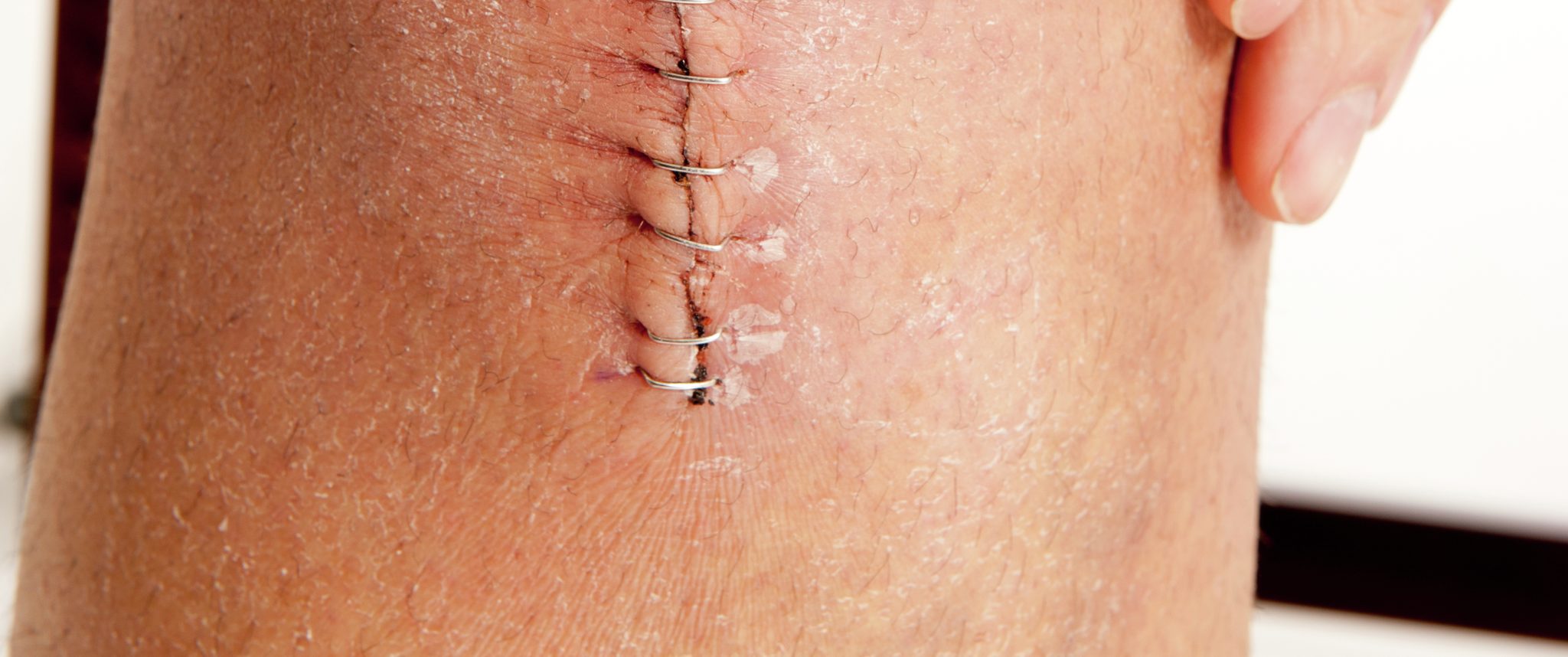 A patient's scars after knee surgery