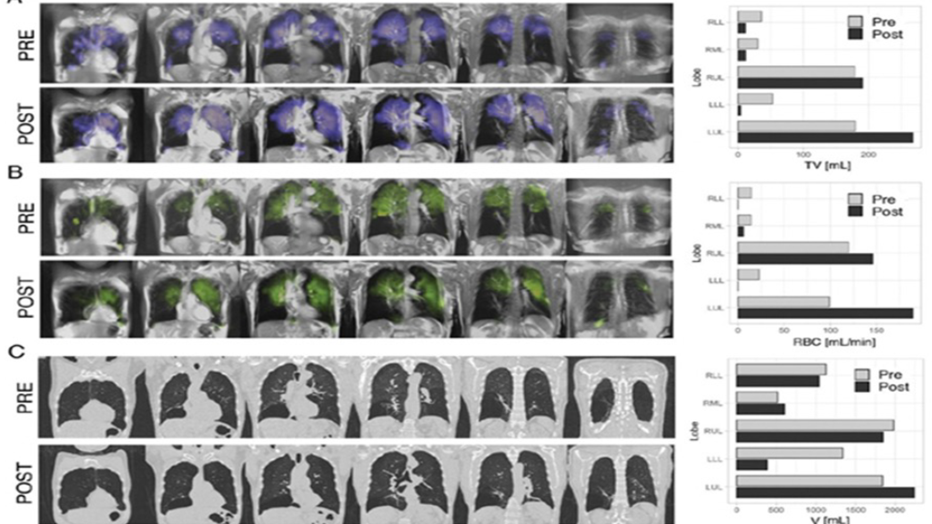 Imaging and chart visualization of ventilation and gas exchange in a patient before and after endobronchial valve placement for COPD