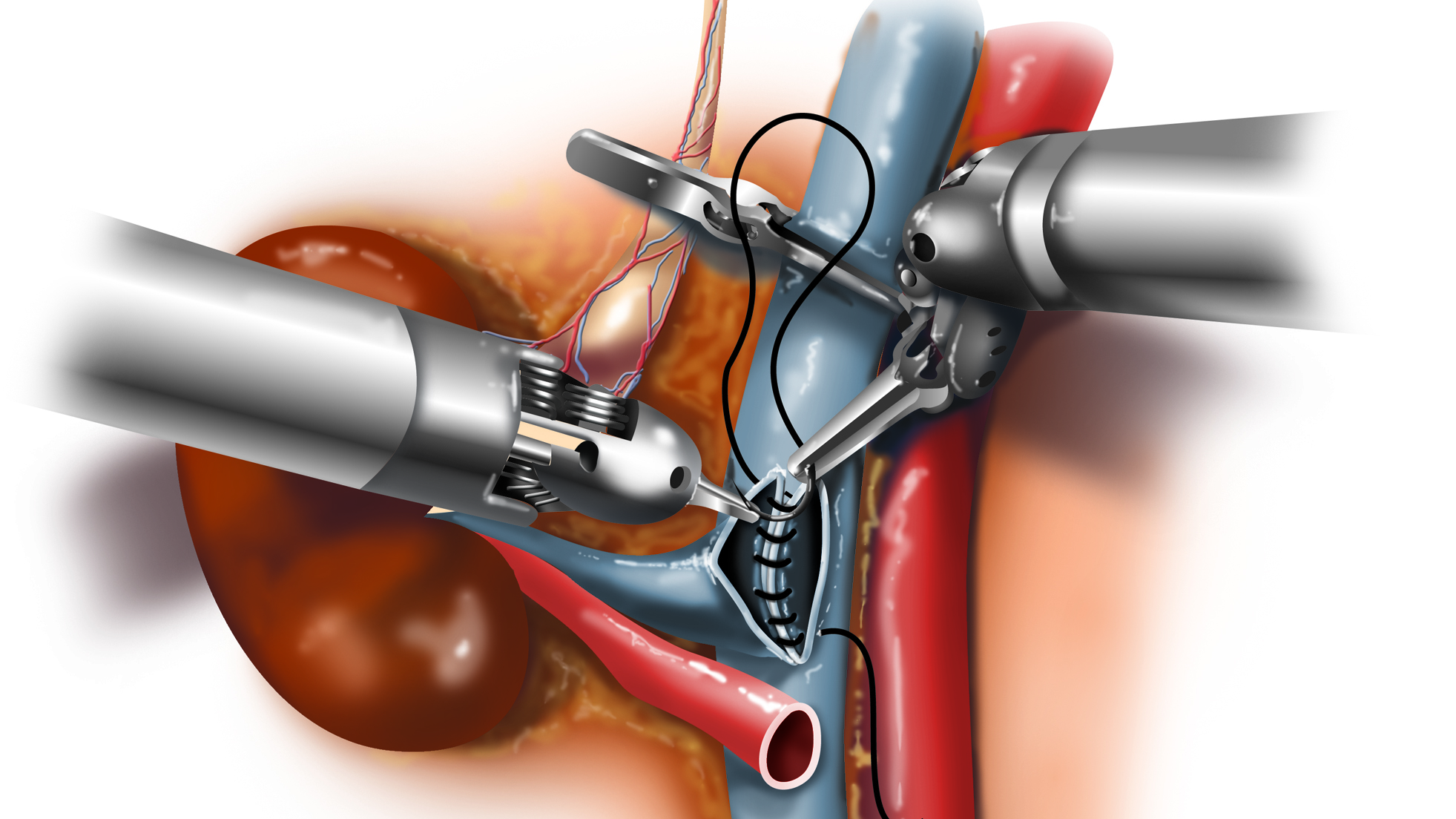 animated robotic instruments suturing the vessels of a kidney in a transplant recipient