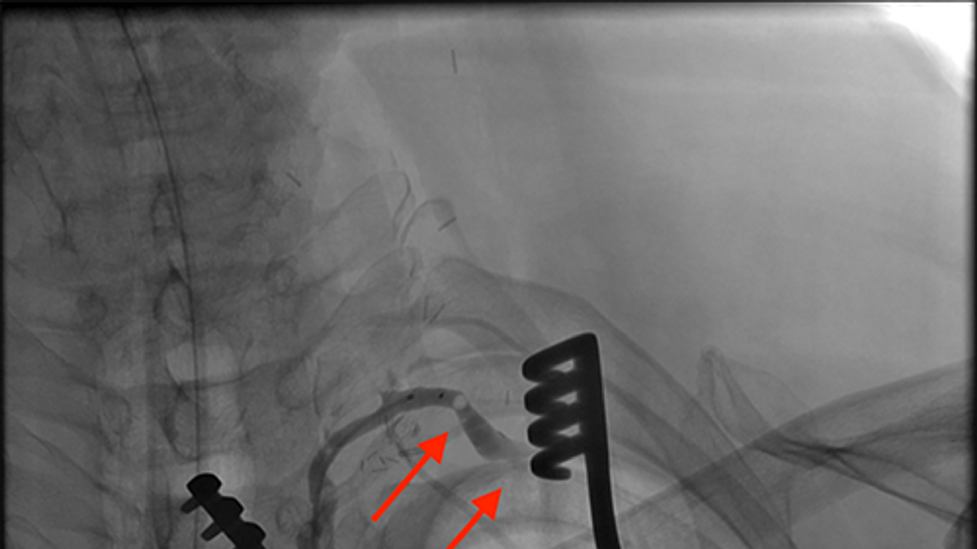 Confirmation of patent anastomosis