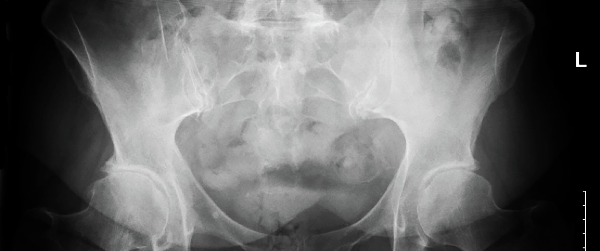 Hip X-ray