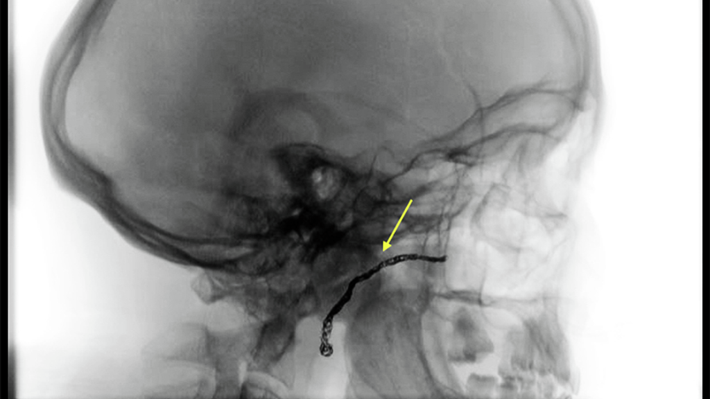 Skull x-ray shows complete blockage of the internal maxillary artery near the temporomandibular joint