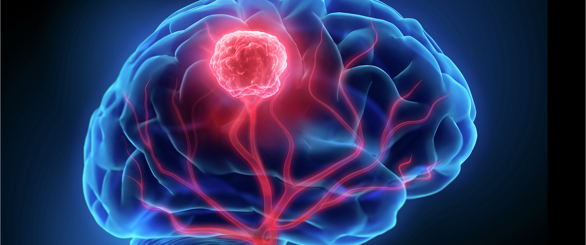 An artistic rendering of the brain with a large central tumor.