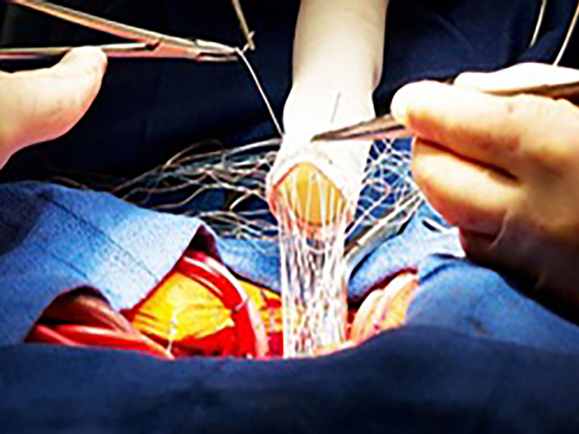 Surgeons sew a graft onto the aorta