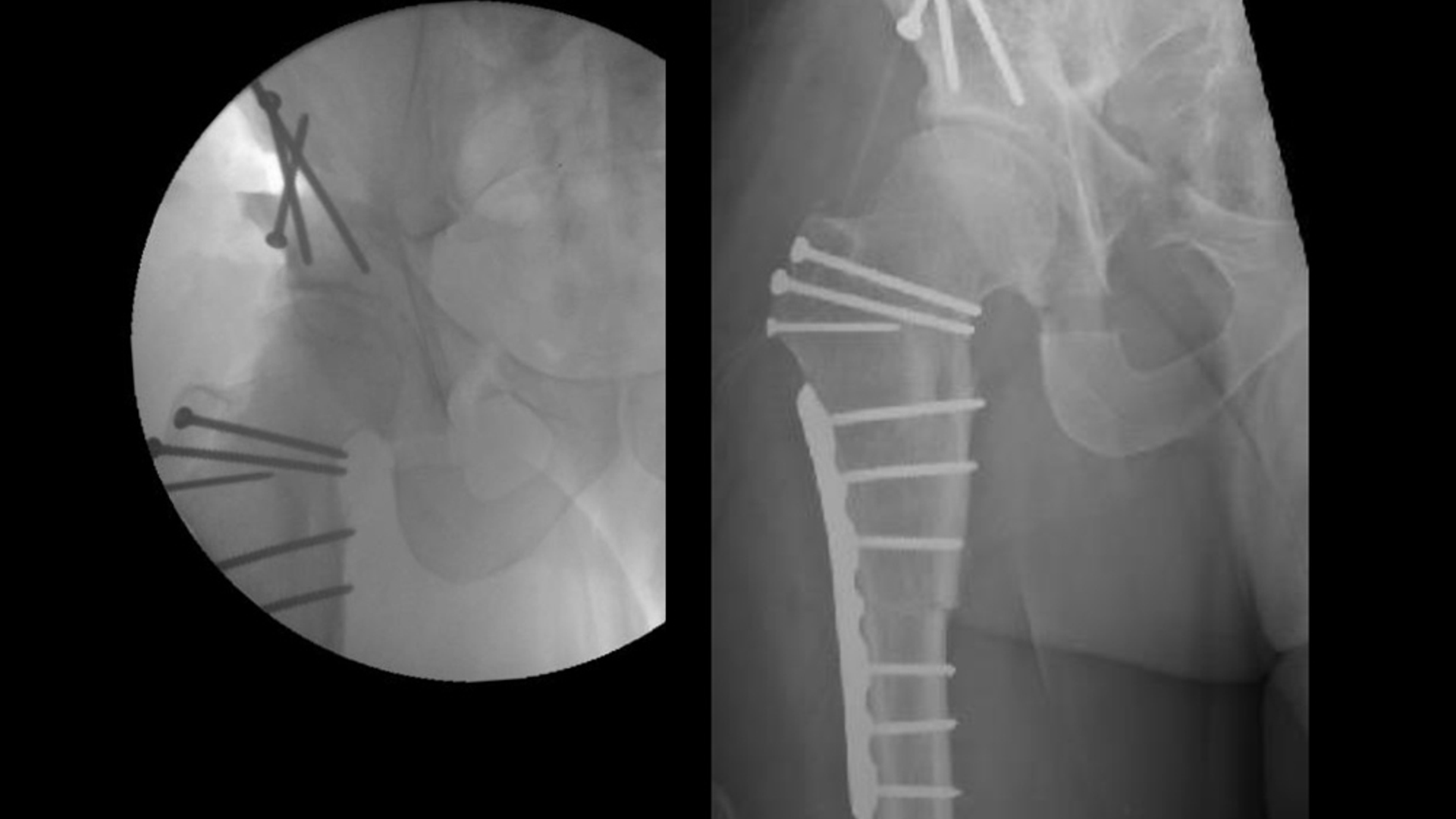 X-ray  of a patient demonstrating fixation of periacetabular osteotomy
