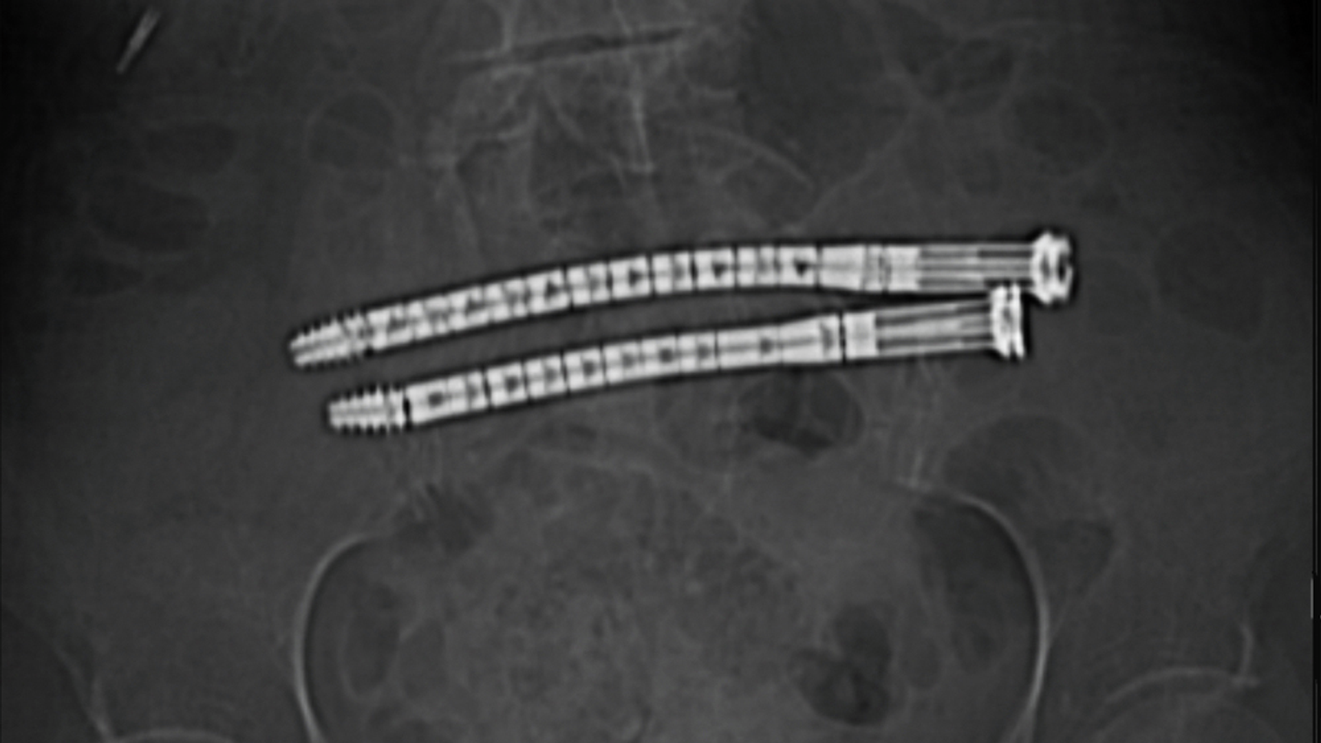Curved CURVAFIX screws spanning pelvic fracture