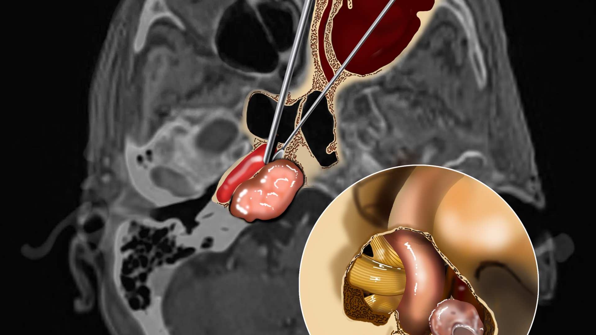 Complete microsurgical resection of deep-seated brain tumor at carotid artery